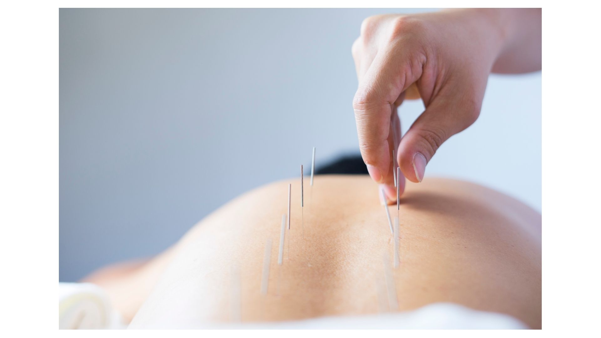 The Surprising Benefits of Acupuncture for Modern Life