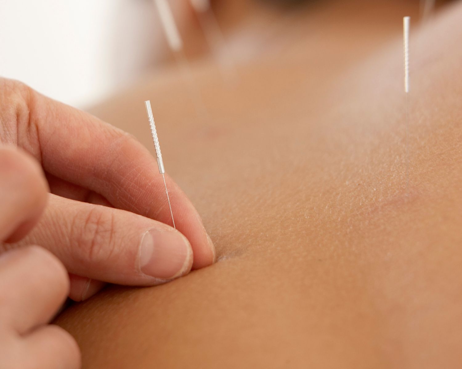 How Chiropractic + Acupuncture Work Together at Meylor