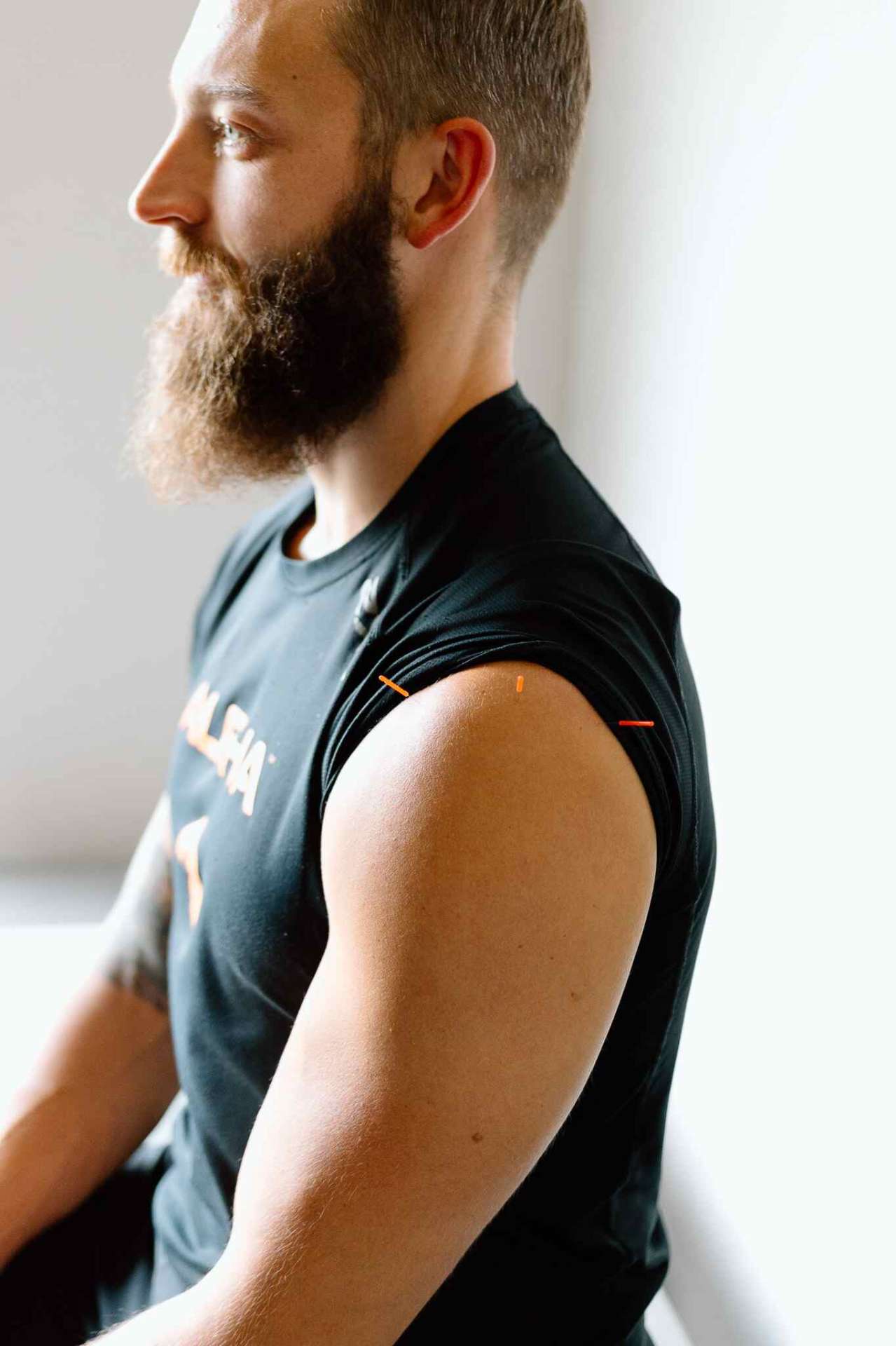 Lenexa acupuncturist Dr. Meylor placing therapeutic acupuncture needles for pain relief